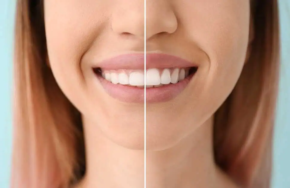 Osseous Surgery in Mount Pleasant, SC by Periodontic Specialists by Solomon Dental