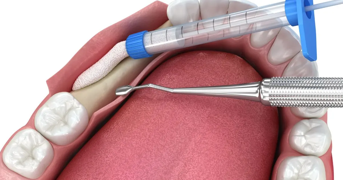 Soft tissue gum grafting procedure for periodontal disease treatment by Solomon Dental
