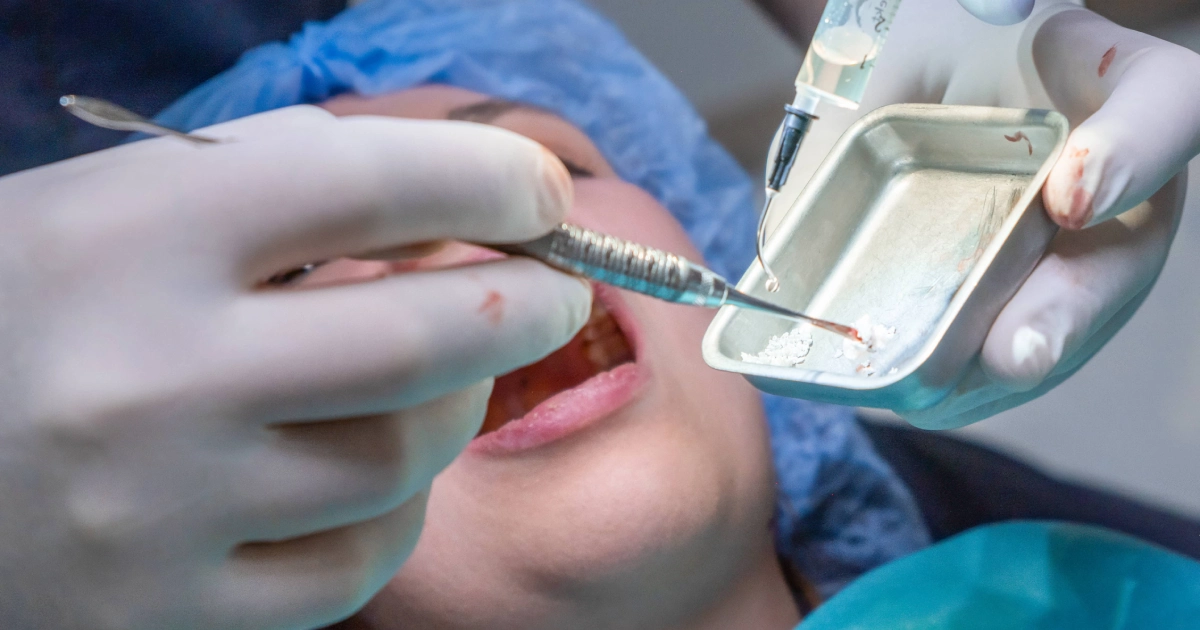 A dentist wearing gloves prepares dental materials while a patient lies back with their mouth open during an Osseous Surgery procedure in Mount Pleasant, SC.