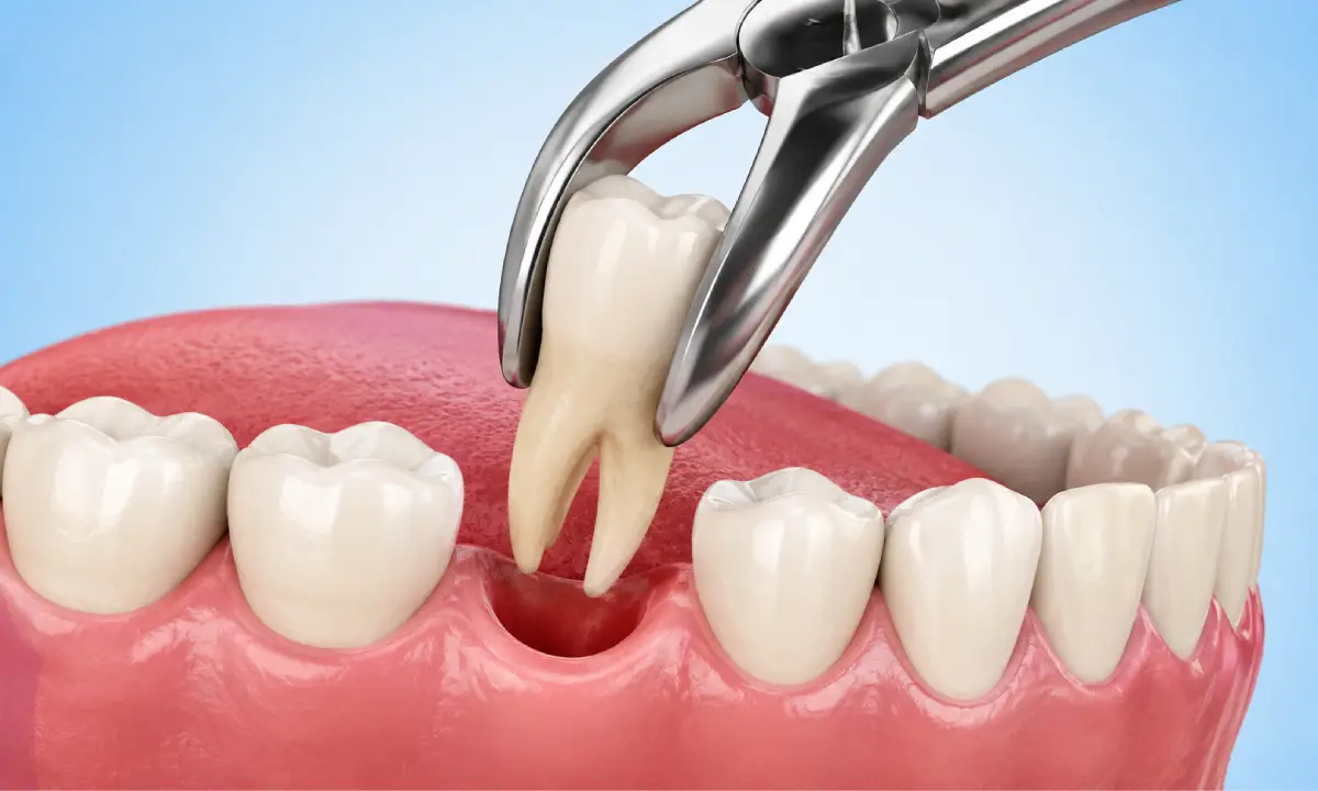 Tooth Extraction in Mount Pleasant, SC